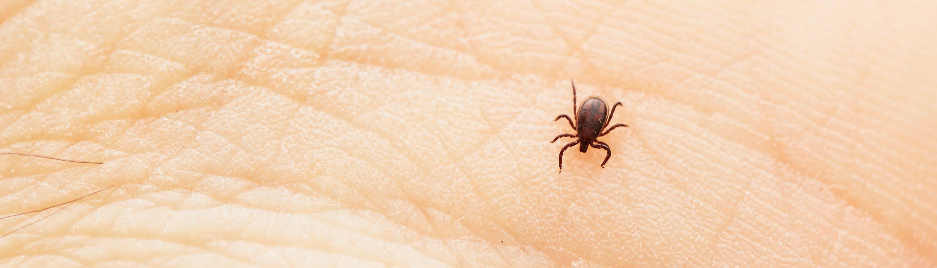 Ticks, Tick Bite, Lyme, Alpha Gal, Rocky Mountain Spotted Fever